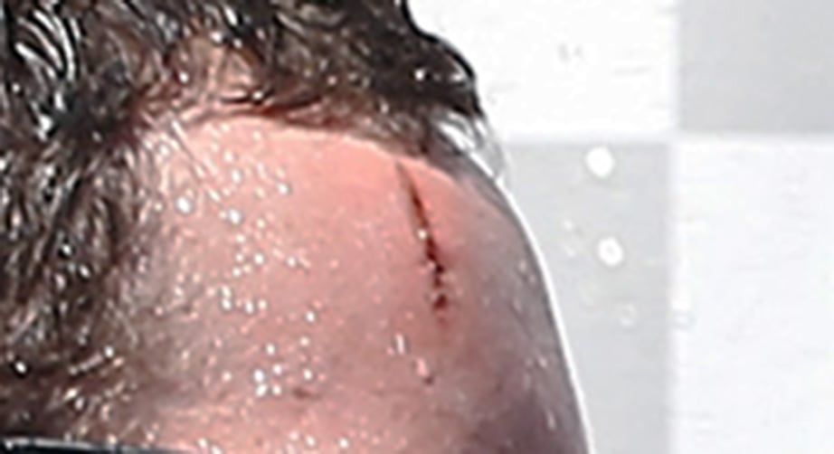 Cole Pearn's forehead